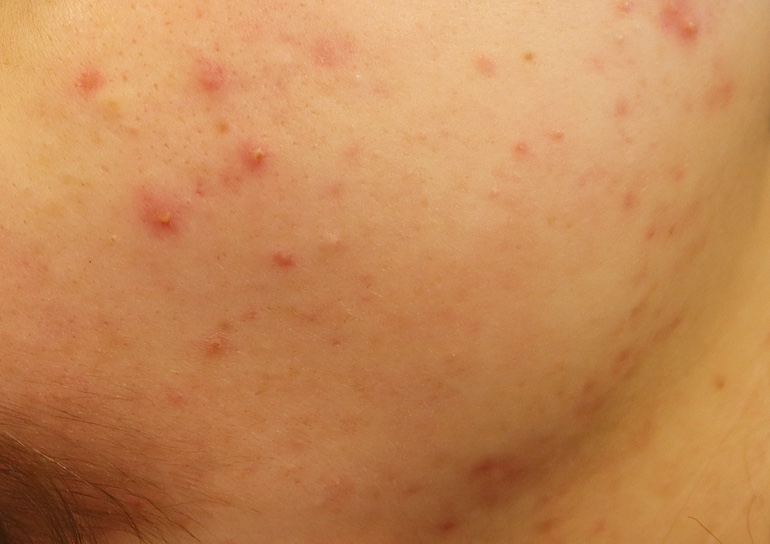 Acne gezicht