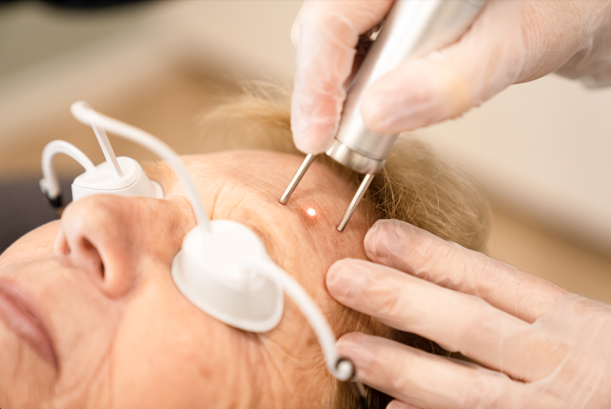 Pigmentlaser