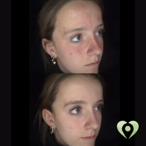 voor_na zonder balk acne (52)