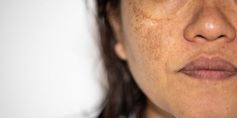 Melasma