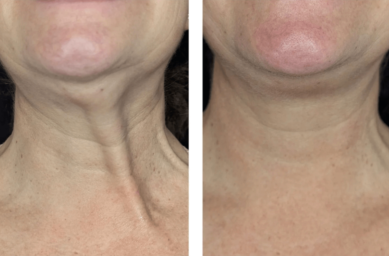 botox behandeling (1)