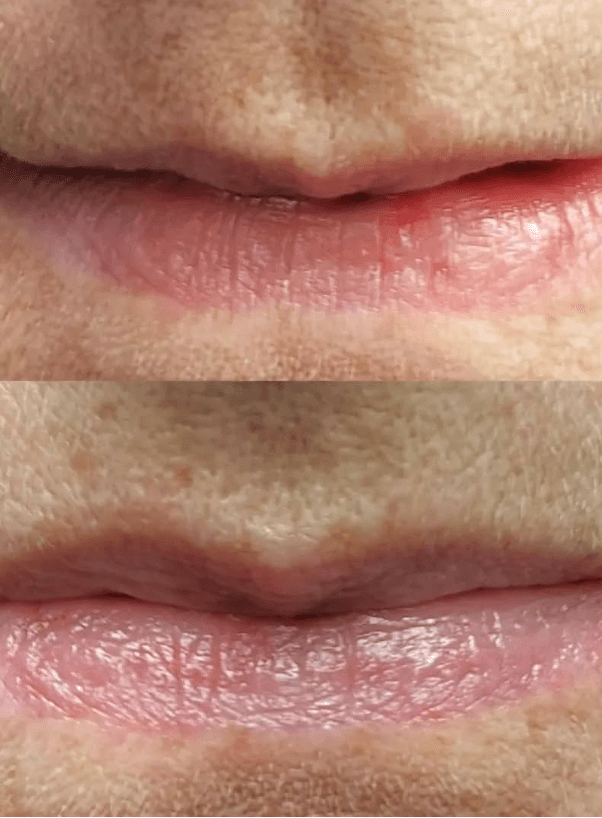 botox behandeling (2)
