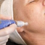 Microneedling