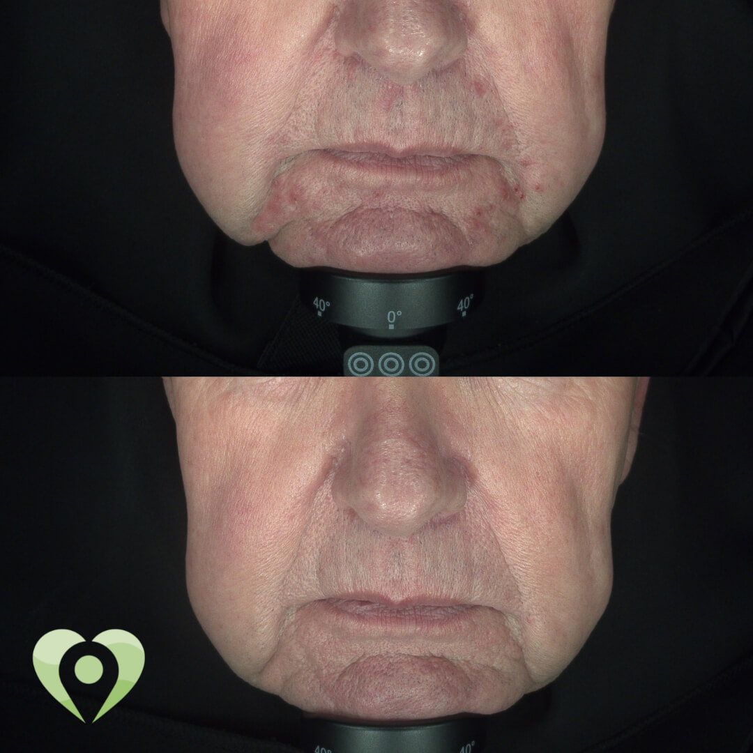 liposoompeeling (1)