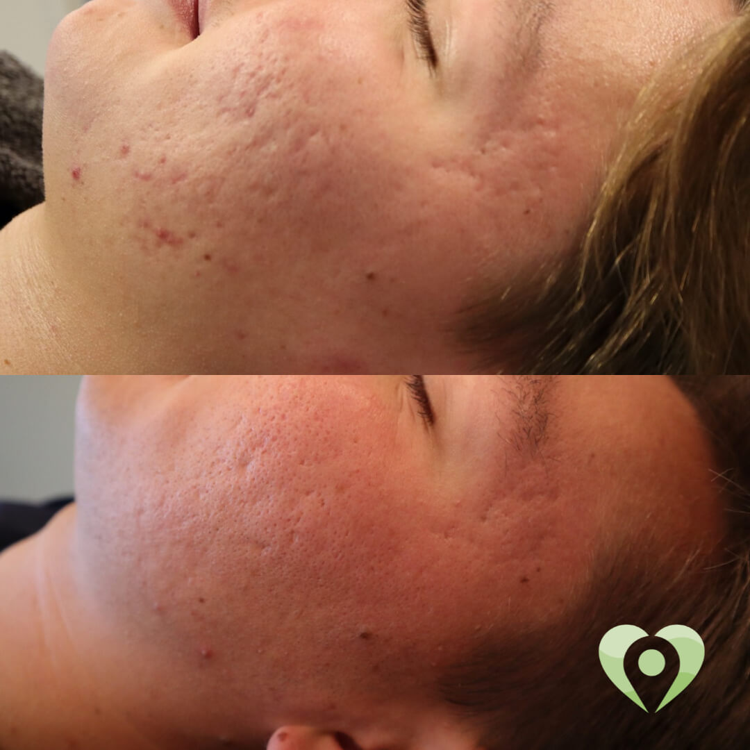 medische microneedling (1)