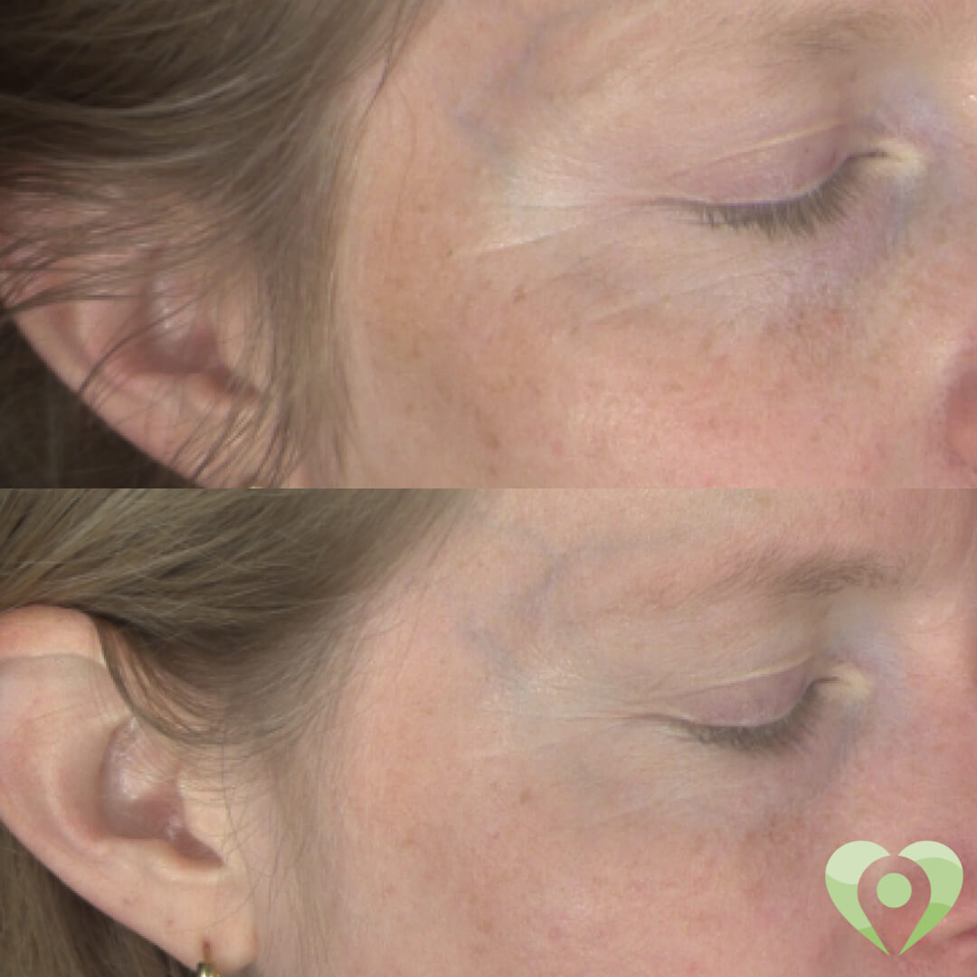 medische microneedling (2)