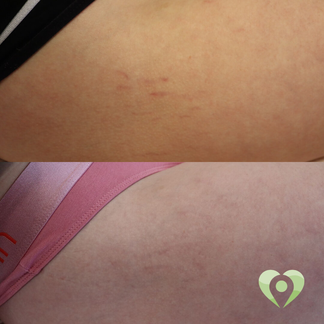 medische microneedling (3)