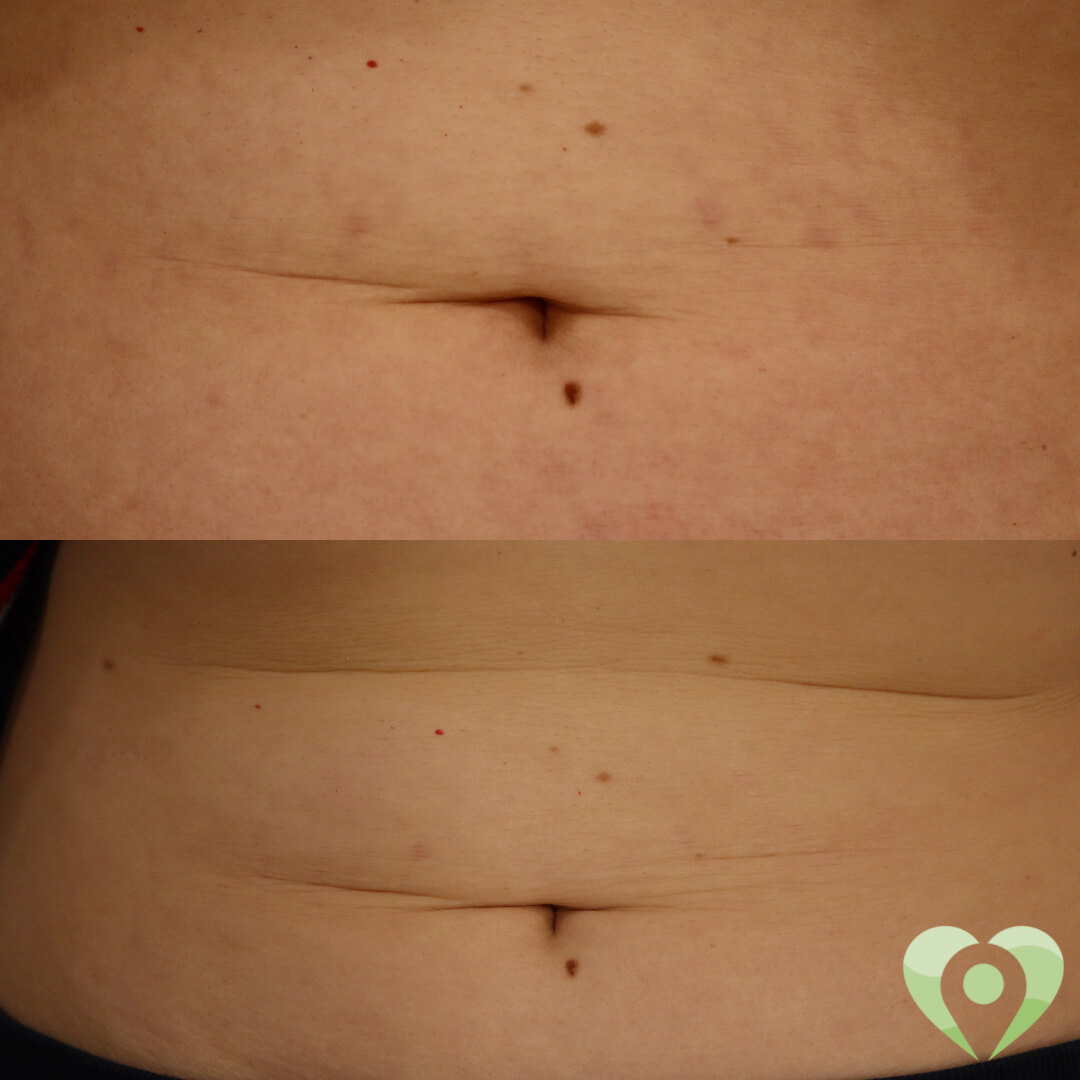 medische microneedling (4)