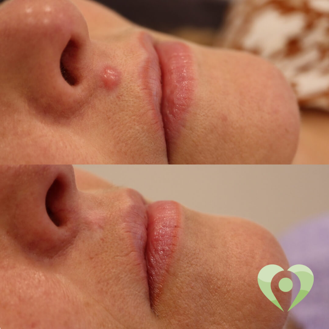 medische microneedling (5)