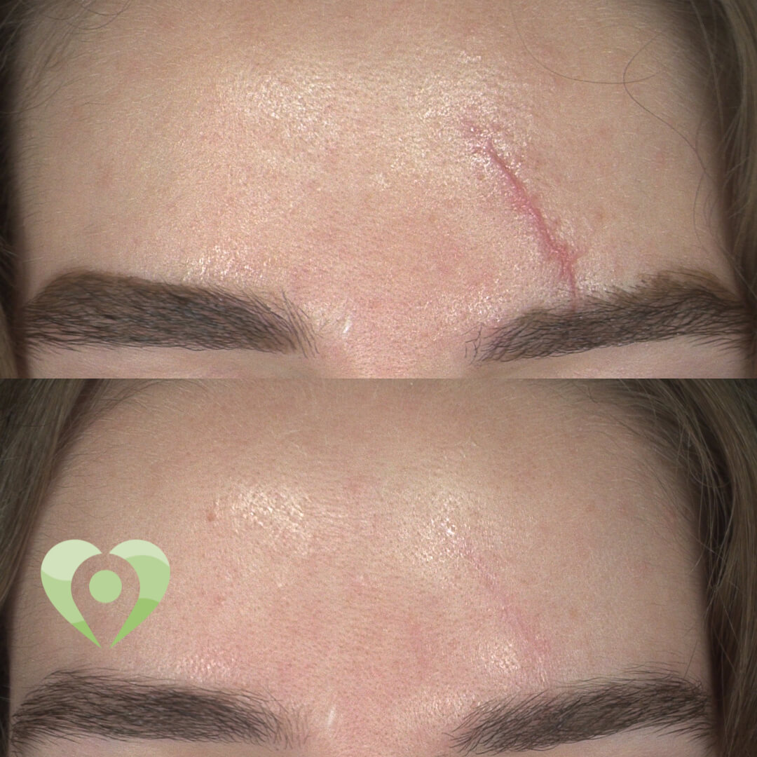 medische microneedling (6)
