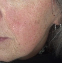 diffuse-roodheid