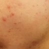Acne gezicht