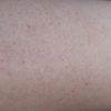 Keratosis pillars