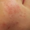 Rosacea