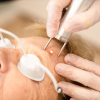 Pigmentlaser
