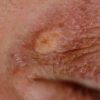 Xanthelasma